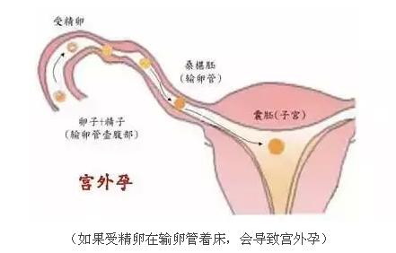 宫外孕主要是男的原因 宫外孕是怎么回事？