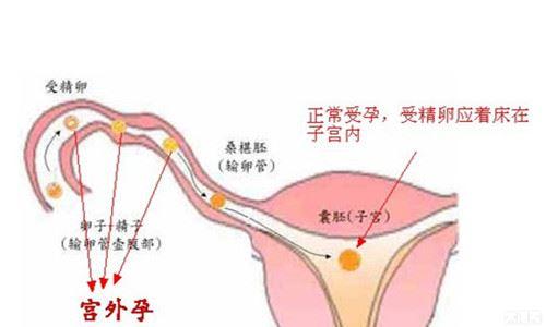 宫外孕的征兆有哪些! 宫外孕的表现有哪些