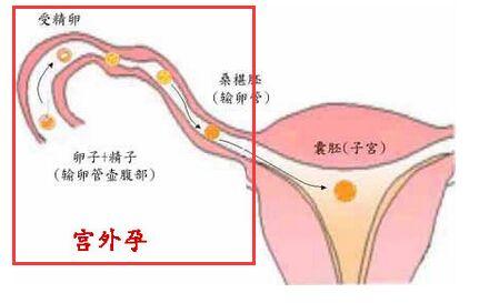 宫外孕试纸能测出吗 宫外孕有哪些症状