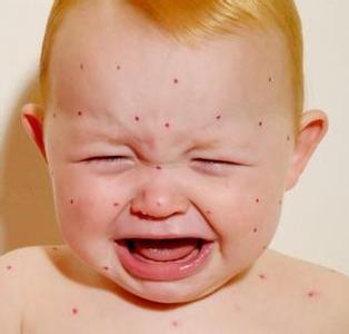 婴儿湿疹最佳治疗方法 宝宝湿疹怎么办