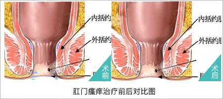 肛门瘙痒原因 引起肛门瘙痒的原因有哪些