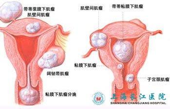 子宫肌瘤怎么治最好 子宫肌瘤是怎么引起的