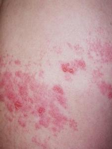 红斑痤疮的早期症状 红斑狼疮的早期症状是什么