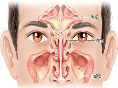 鼻窦炎如何根治 如何区分鼻炎与鼻窦炎