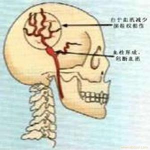 脑供血不足为什么失眠 脑供血不足失眠怎么办