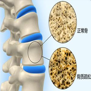 如何判断骨质疏松 如何判断是否骨质疏松