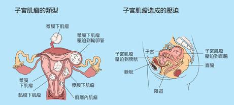 子宫肌瘤术后吃什么好 子宫肌瘤术后要怎么吃