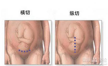 剖腹产后遗症有哪些 剖腹产常见的4个后遗症