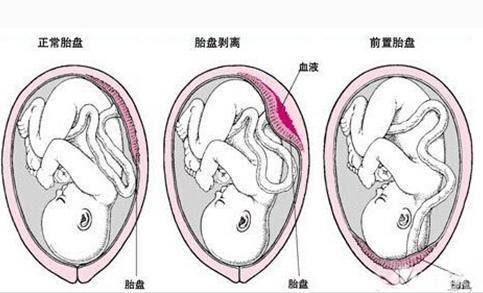 后壁生女孩几率大不大 胎盘后壁生男生女