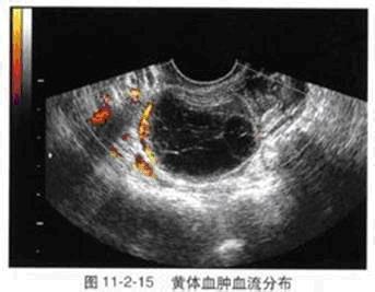 黄体囊肿需要治疗吗 什么是黄体囊肿