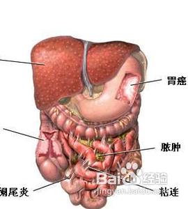 阑尾炎并发症 阑尾炎的并发症有哪些