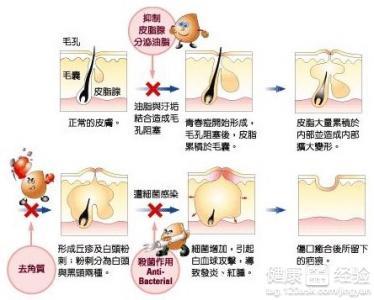 青春痘有效治疗办法 分享怎么有效治疗青春痘的办法