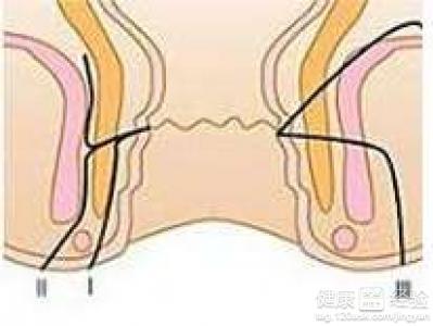 肛门湿疹的发病原因 细数肛门痒的七大发病原因
