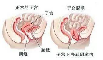 生小孩了,子宫会下垂吗 产后为什么子宫会下垂