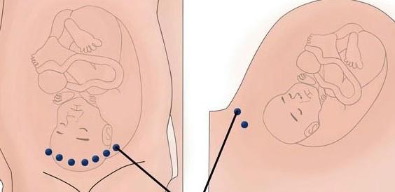 剖腹产后应该怎样睡姿 剖腹产7天之内的睡姿