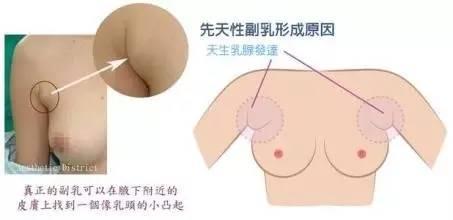 教你如何消除副乳 如何预防副乳