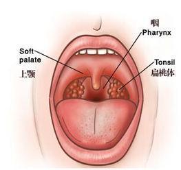 急性咽炎是怎么引起的 急性咽炎和慢性咽炎的区别