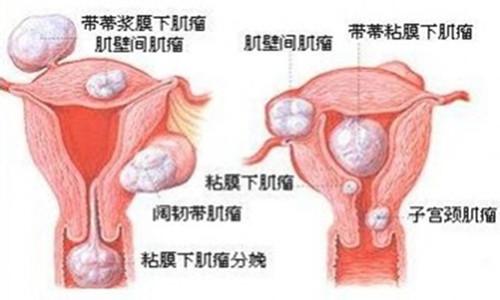 子宫肌瘤1.8厘米大吗 引起子宫肌瘤的原因有哪些