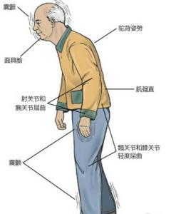 帕金森病人能活多久 帕金森病的症状