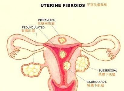 有子宫肌瘤哪些不能吃 子宫肌瘤不能吃哪些食物