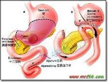 胆汁反流性胃炎 胆汁反流性胃炎做好两大保健