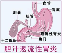 胆汁反流性胃炎 怎样防胆汁反流性胃炎