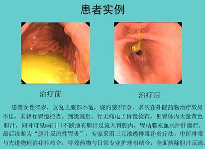 胆汁反流性胃炎的食谱 胆汁反流性胃炎吃什么食物好