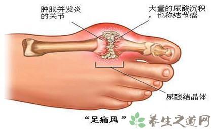 痛风特效药 治疗痛风的简单方法