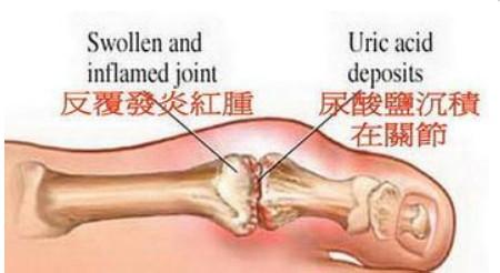 痛风病可怕吗 什么是痛风病