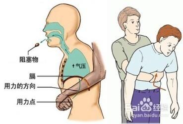 鱼刺卡在喉咙怎么办 鱼刺卡在喉咙里的危害是什么