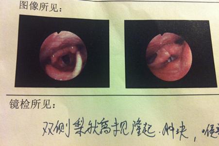 瓜子壳卡在喉咙2天了 瓜子壳卡喉咙怎么办