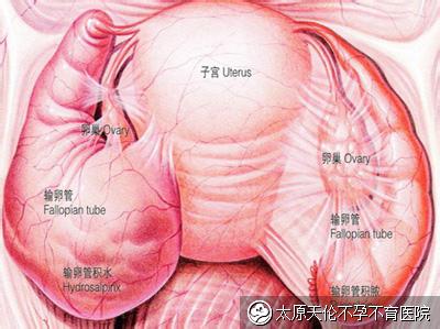 输卵管积水可以自愈吗 输卵管积水的症状