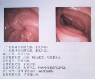 慢性浅表性胃炎严重吗 慢性浅表性胃炎的症状