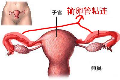 输卵管粘连怎么治最好 输卵管粘连症状