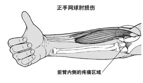 如何预防网球肘 如何预防网球肘的妙招