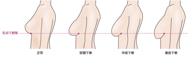 产后如何预防乳房下垂 预防乳房下垂有三招