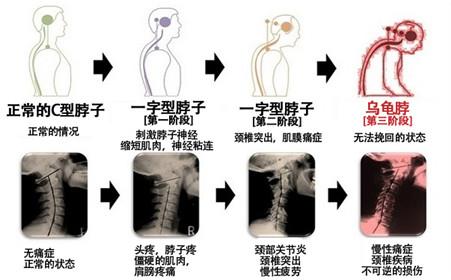 颈椎病早期症状是什么 颈椎病的症状是什么