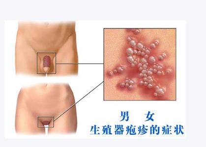 怎样预防生殖器疱疹 预防生殖器疱疹的9个小常识