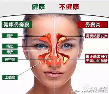 鼻窦炎的最好治疗方法 鼻窦炎症状