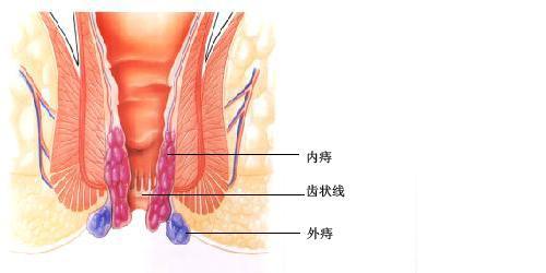 内痔外痔如何区分图片 如何区分内痔和外痔