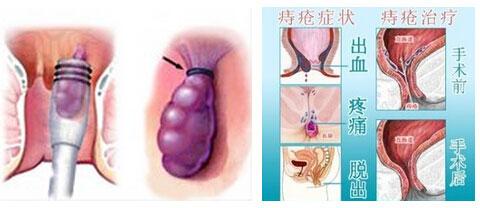 痔疮出血怎么办 痔疮出血怎么办好