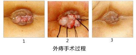 如何消除痔疮肉球 如何消除痔疮