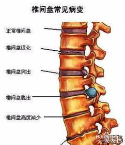 怎么判断腰椎间盘突出 腰椎间盘突出防治