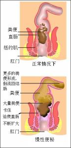 便秘的原因及解决办法 便秘是如何形成的