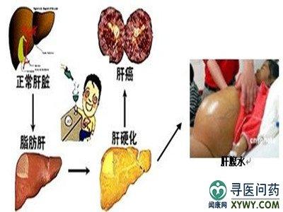 中青年人群 中青年人群易发三型股癣