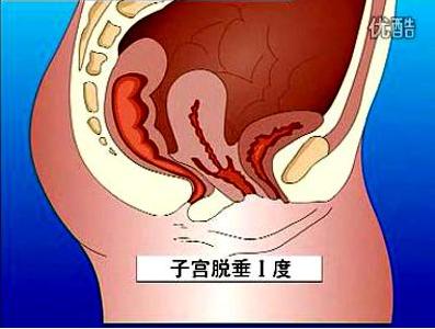 肾气虚 子宫脱垂与气虚或肾虚有关