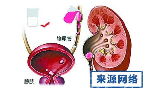 腰疼是肾病吗 经常性肾疼是否是换了肾病？