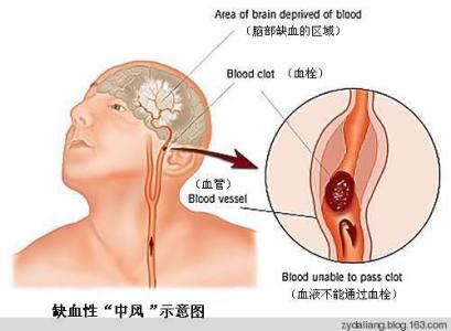 治疗脑血栓的特效药 脑血栓治疗方法