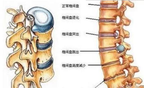 腰椎骨质增生治疗 什么是腰椎骨质增生 腰椎骨质增生发病原因 腰椎骨质增生治疗方法