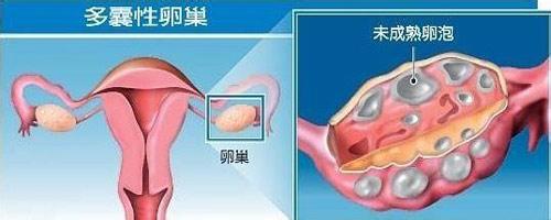 多卵巢综合征怎么引起 多囊卵巢综合症是怎么回事